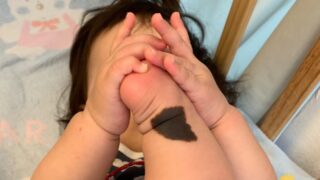赤ちゃんの足首にある黒いアザ