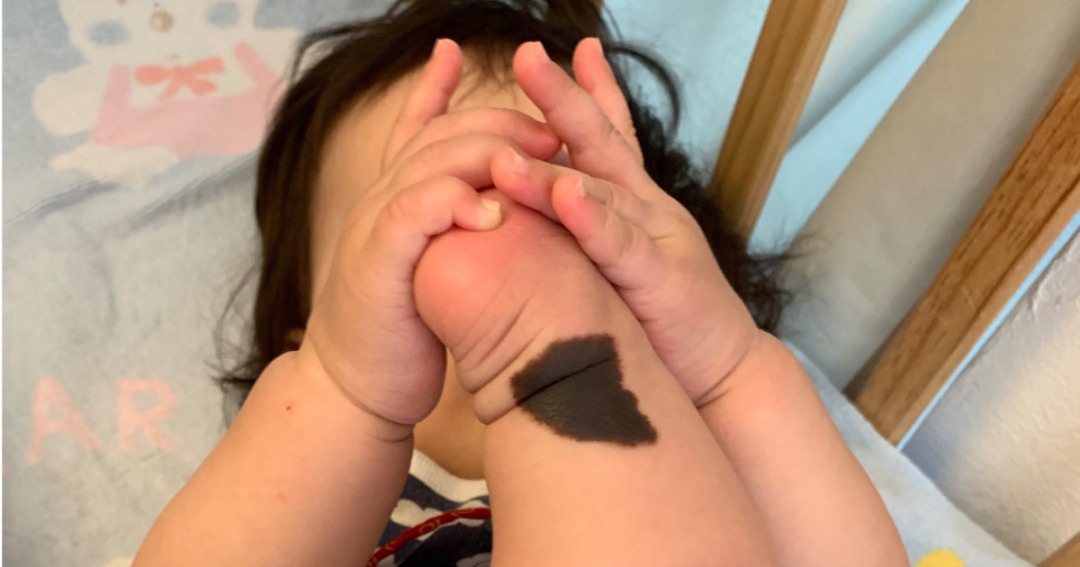 赤ちゃんの足首にある黒いアザ