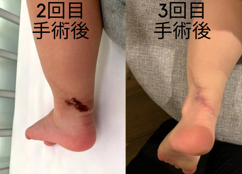 黒色母斑切除手術3回目手術後の子供の足の写真
