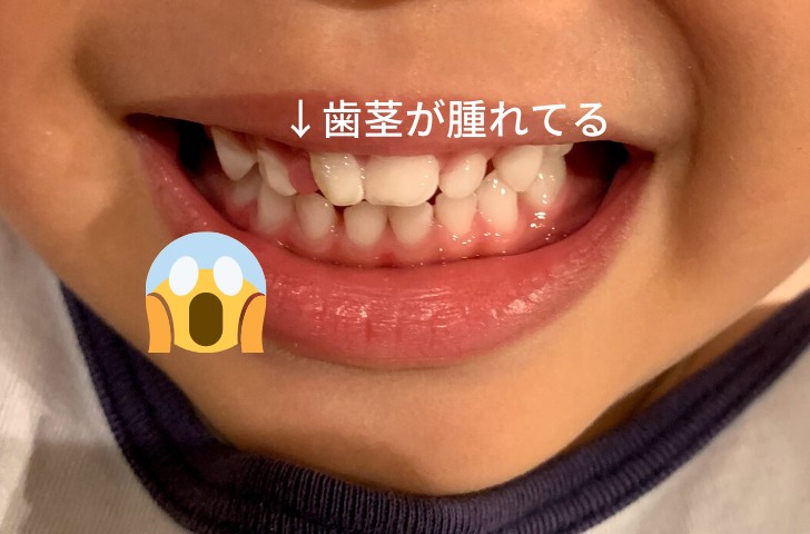 なくなった歯の歯茎の部分が腫れている